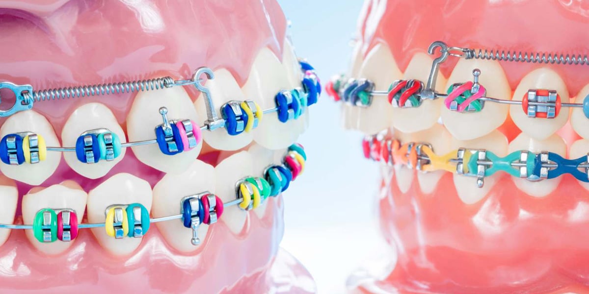 Colores de brackets: ¿Cuáles debes escoger?