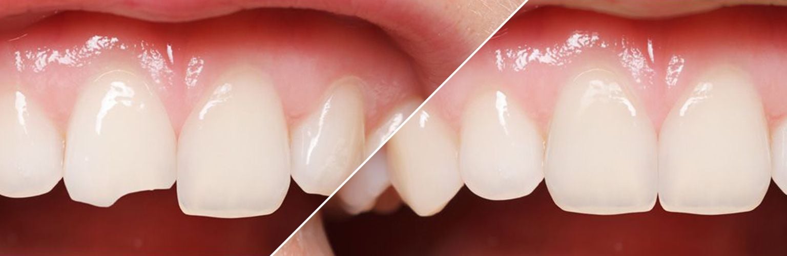 Sabe cómo se colocan las carillas dentales sin desgaste? - Estética dental