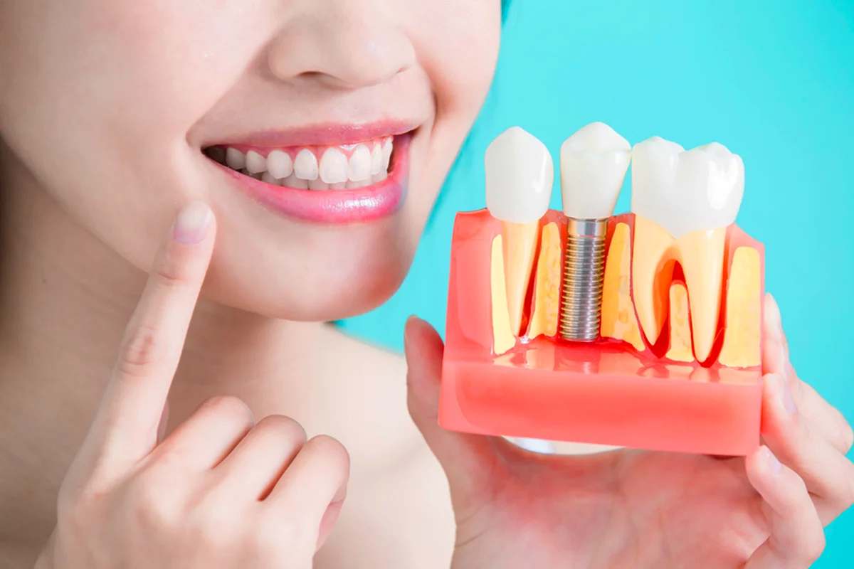Consejos a tener en cuenta después de un implante dental