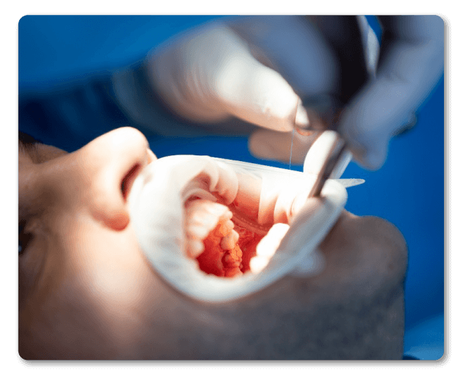 Cuidados después de un procedimiento de endodoncia