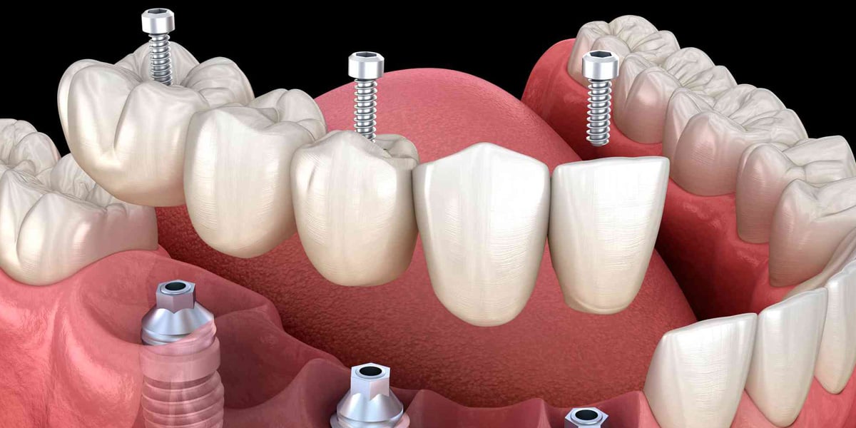 De qué están hechas las prótesis dentales