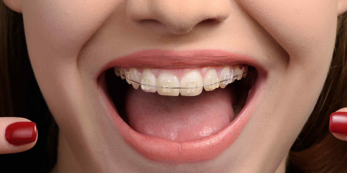 La duración de la ortodoncia en adultos