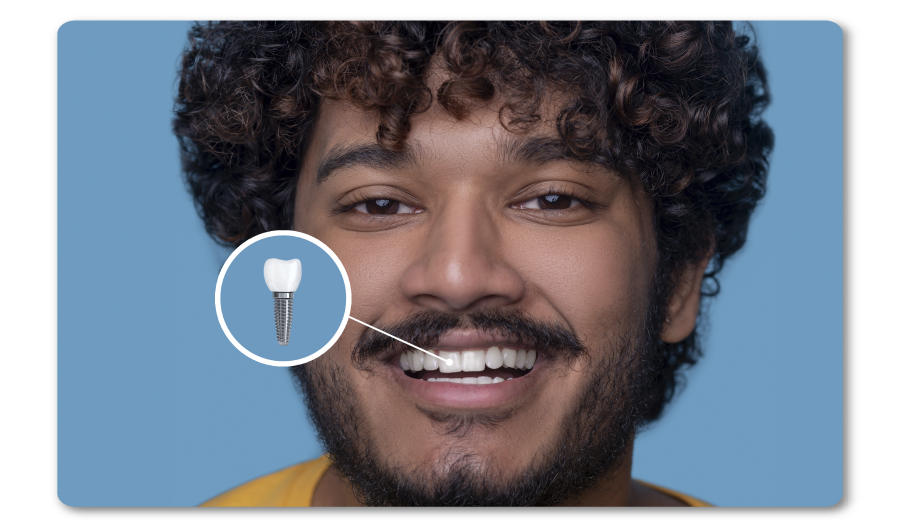 Implantes Dentales
