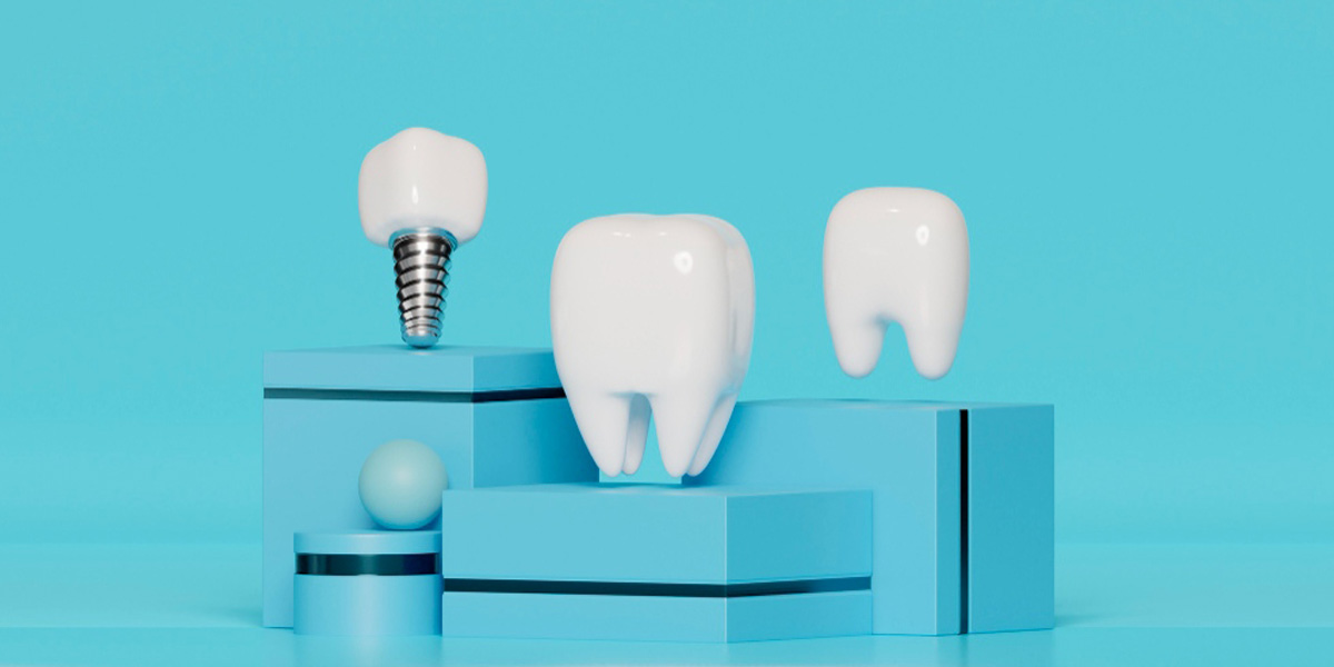 Implantes dentales y coronas ¡Embellecen tu sonrisa!