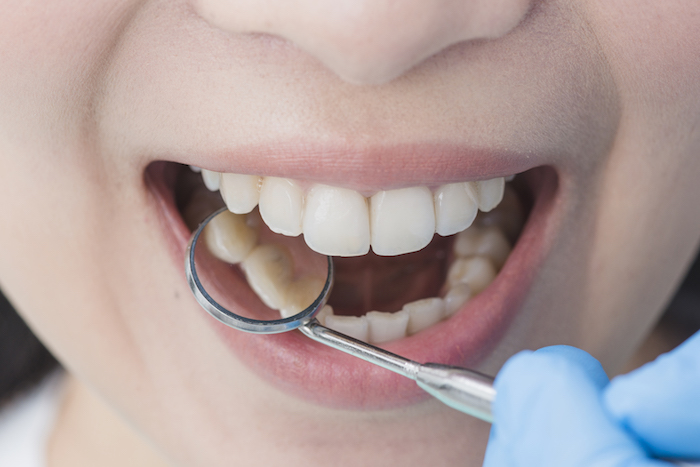 Básicos de la salud oral: ¿Cómo eliminar el sarro dental?