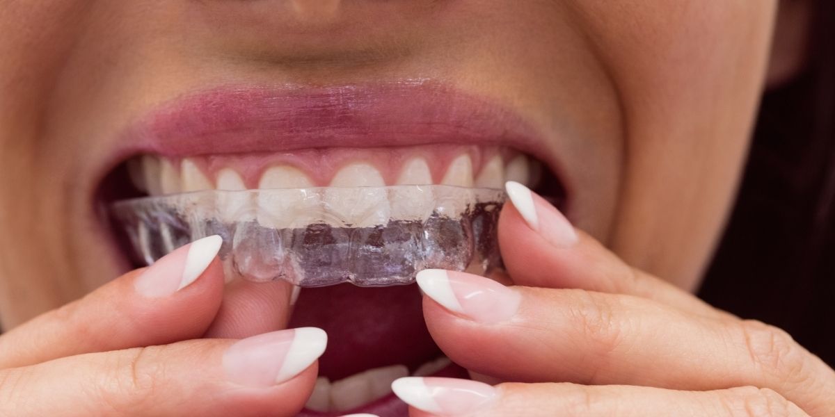 Invisalign en DentiSalud ¿Por qué optar por nuestros alineadores transparentes?