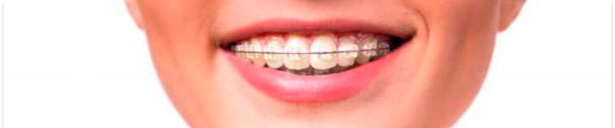 ortodoncia-medellin-brackets-autoligado