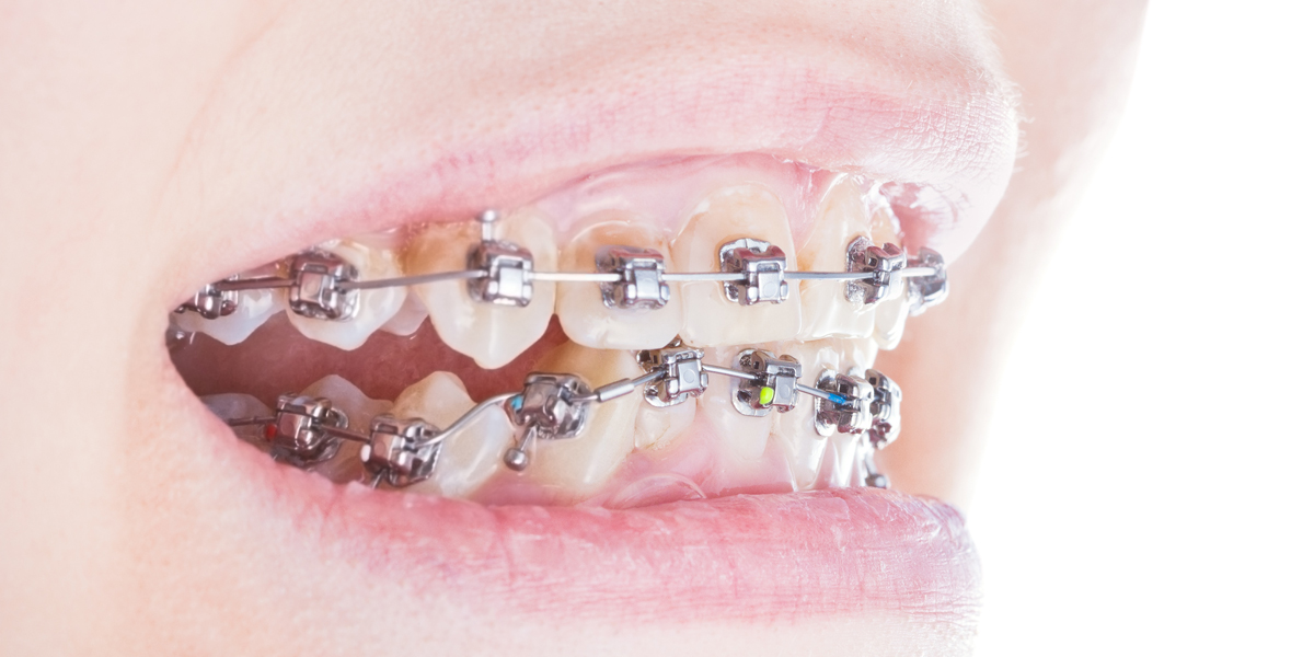 Brackets autoligado: ¿Por qué deberías elegirlos?