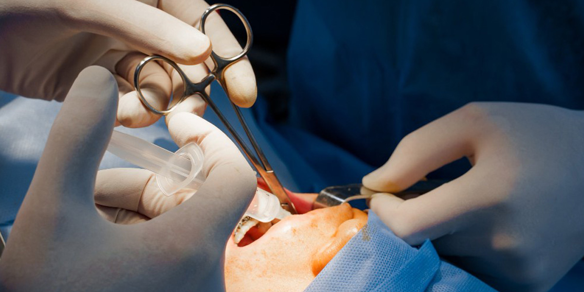 Qué es la cirugía oral