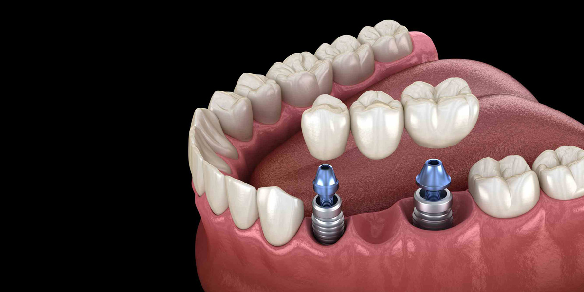 Qué son y cómo funcionan los implantes dentales