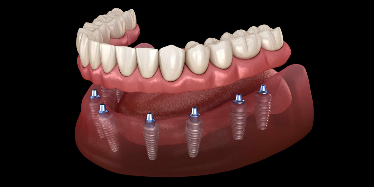 Quiénes pueden optar por implantes dentales