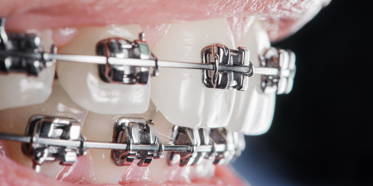 Las razones para elegir brackets de autoligado