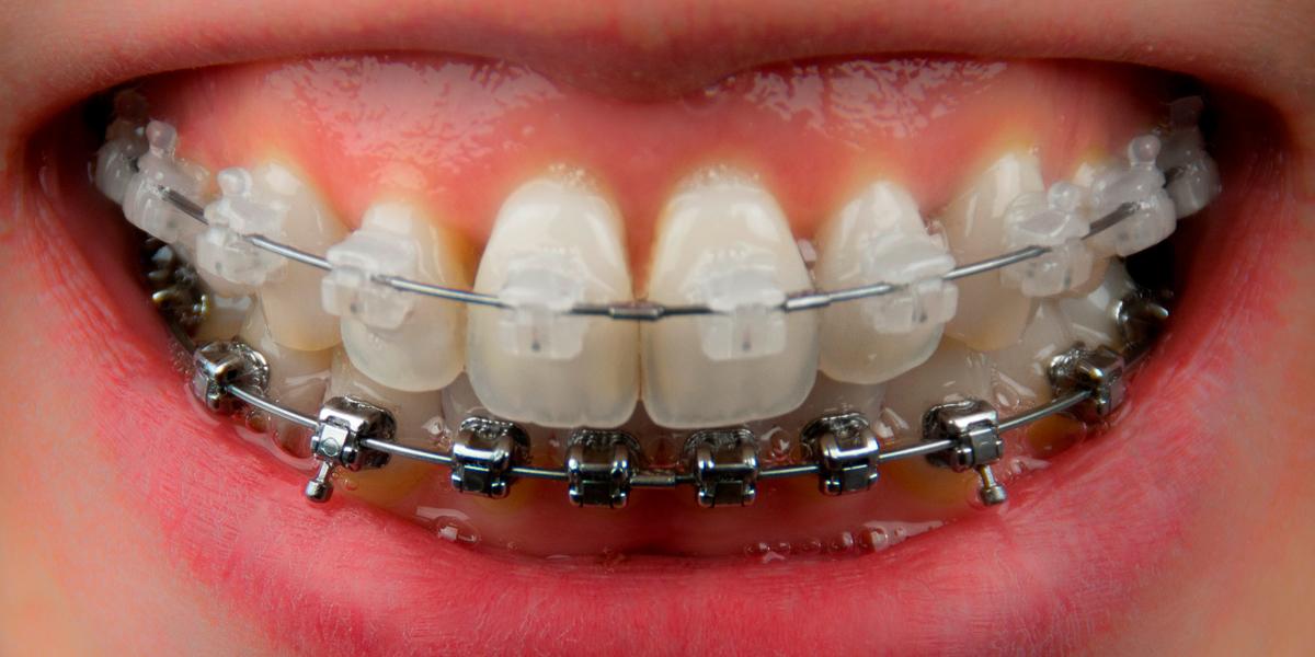 Los tipos de brackets autoligado