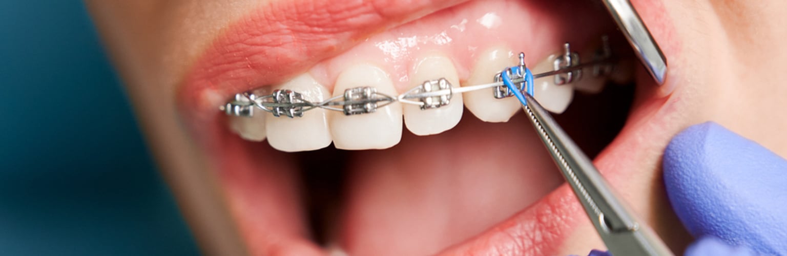 Tipos de Brackets para Obtener una Sonrisa Espectacular