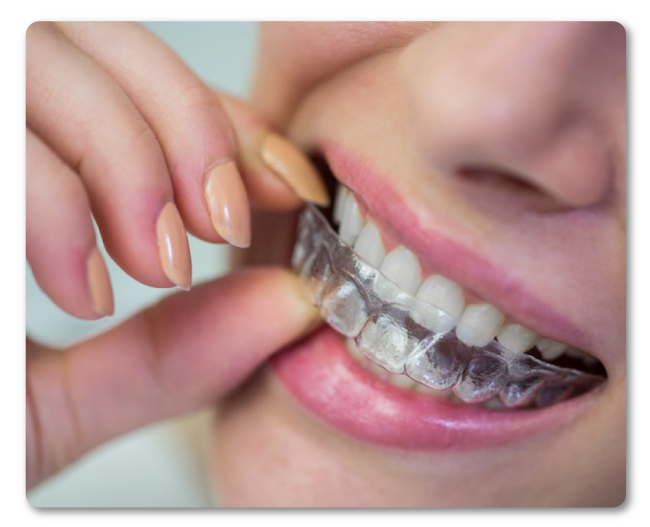 Tratamientos odontologicos ortodoncia invisible