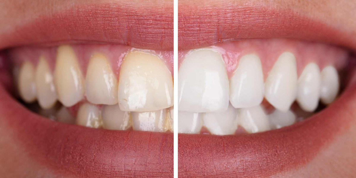 Tratamientos para eliminar manchas en los dientes