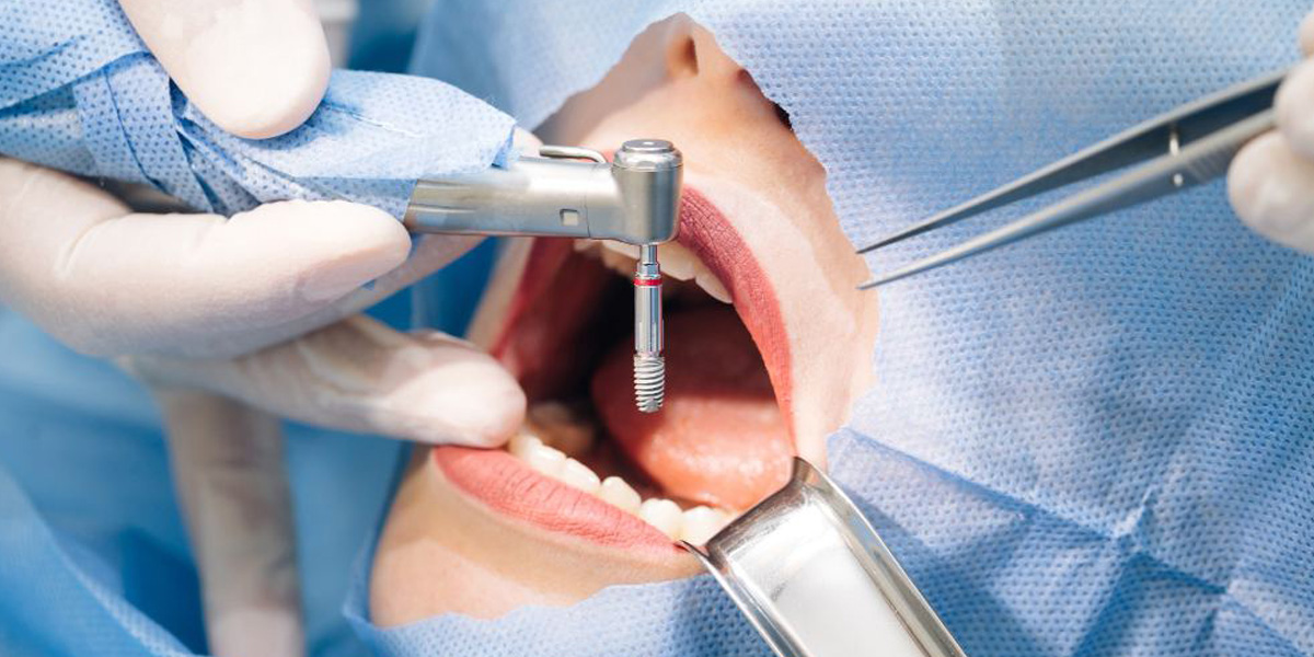 Periodoncia: Tratamientos que te ofrece DentiSalud